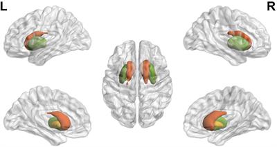 Altered striatal functional connectivity and structural dysconnectivity in individuals with bipolar disorder: A resting state magnetic resonance imaging study